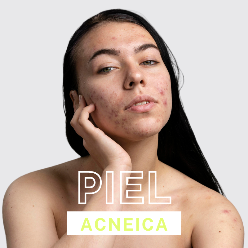 Piel Acneica